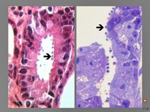 M,33y. | microsporidiosis (or cryptosporidiosis) - duodenum-posttransplantation immunodeficiency (HE and semithin section)